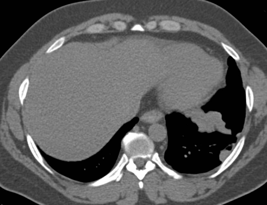 Splenosis Left Chest and Pleural Surface in Patient with a History of Trauma - CTisus CT Scan