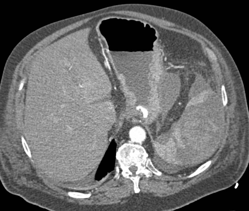 Splenic Infarction - CTisus CT Scan