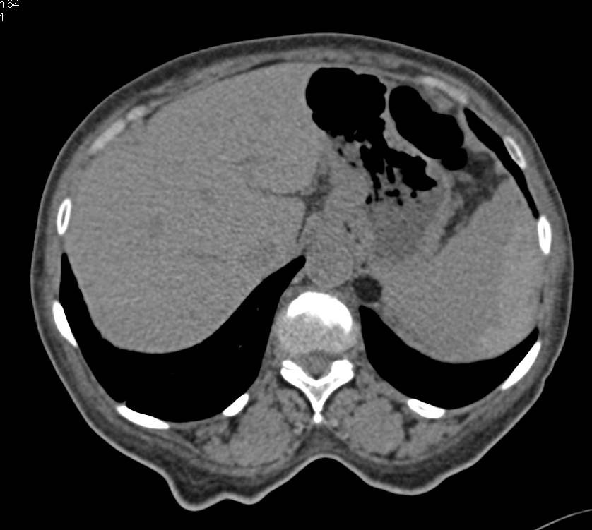 Splenic Laceration with Hemoperitoneum - CTisus CT Scan