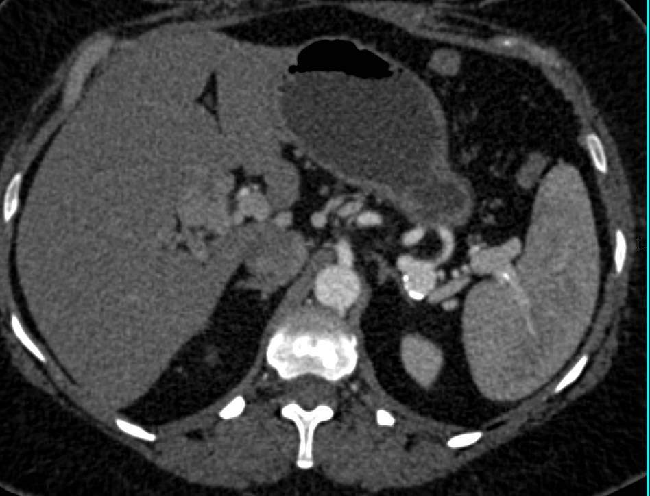 Splenic Artery Aneurysm - CTisus CT Scan