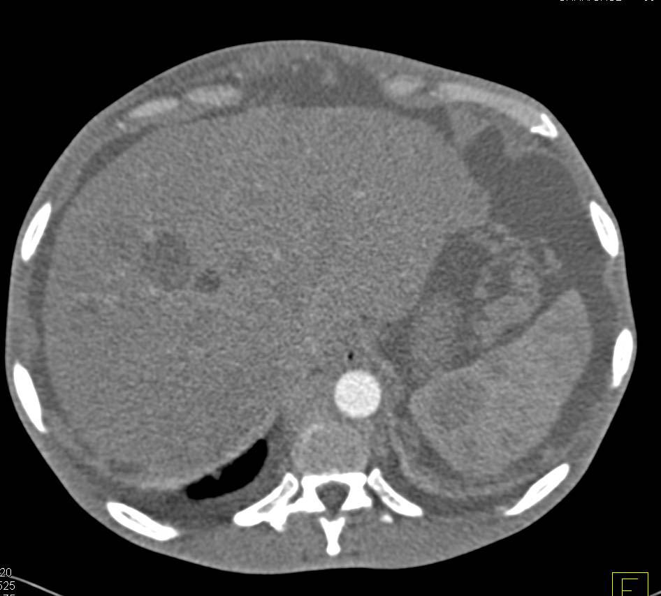 Metastatic Melanoma to Mesentery, Liver , Spleen and Perirenal Zones - CTisus CT Scan