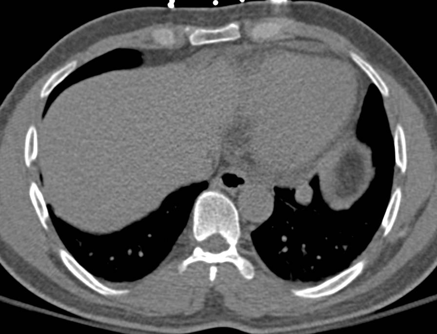 Beautiful Example of Splenosis with Pleural and Parenchymal Lesions - CTisus CT Scan