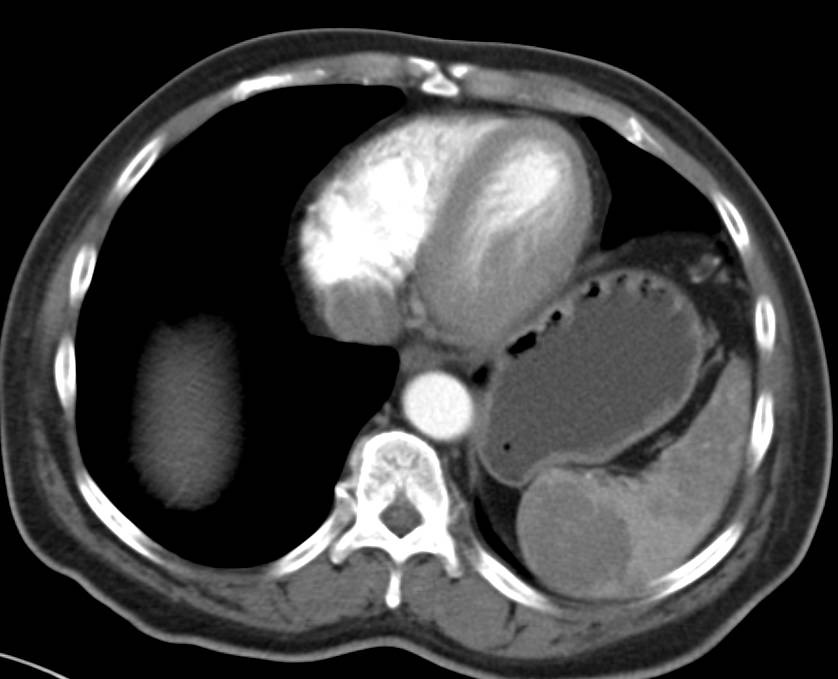 Splenic Hamartoma - CTisus CT Scan