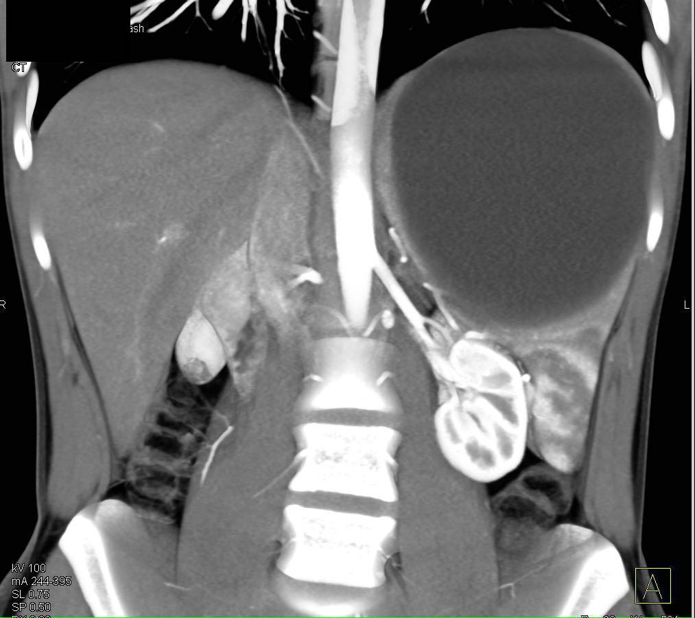 Splenic Cyst - CTisus CT Scan