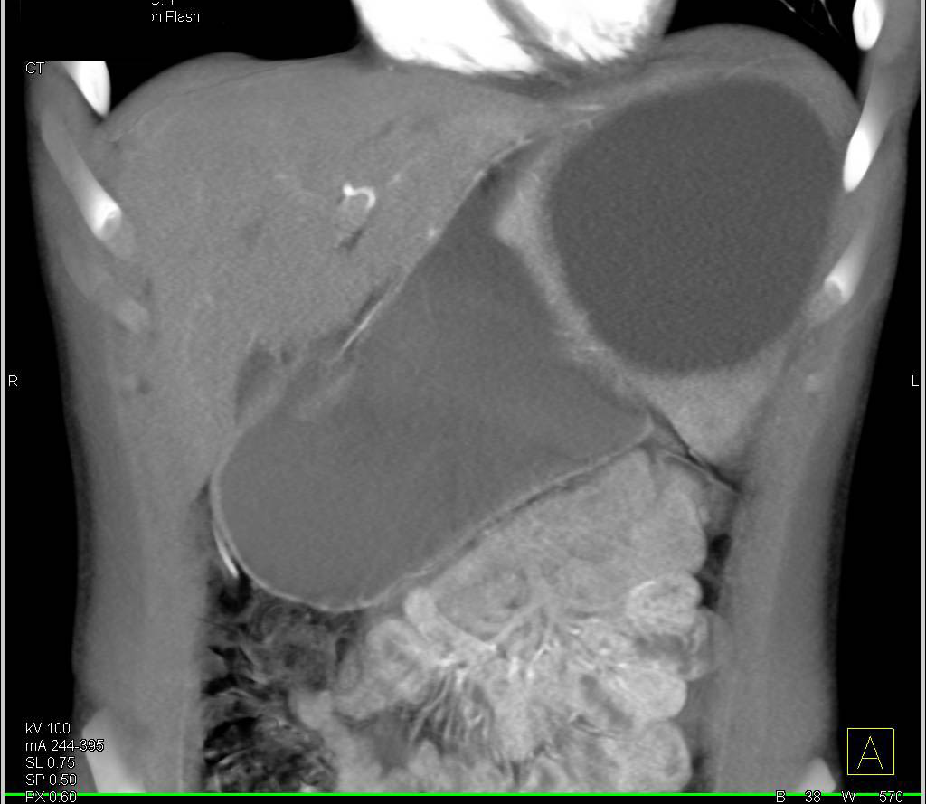 Epithelial Splenic Cyst - CTisus CT Scan