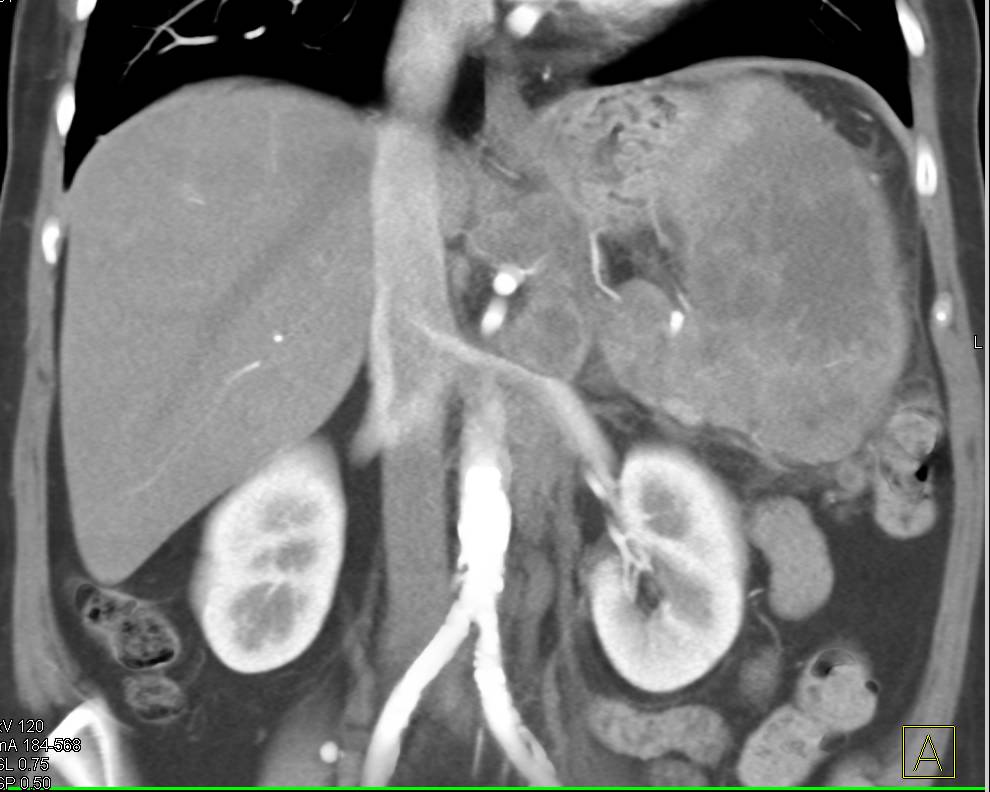 Splenic Lymphoma with Adenopathy - CTisus CT Scan