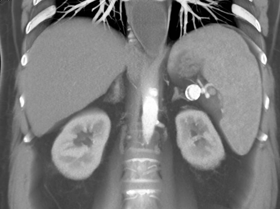 Calcified Splenic Artery Aneurysm - CTisus CT Scan