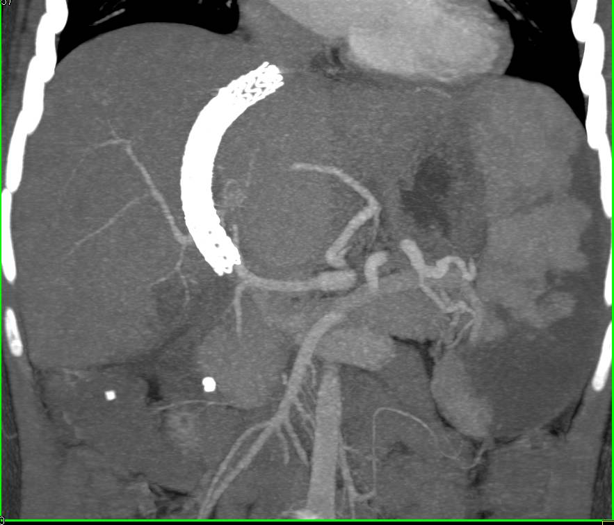 Cirrhosis with Transjugular Intrahepatic Portosystemic Shunt (TIPS) Catheter and Splenic Infarcts - CTisus CT Scan