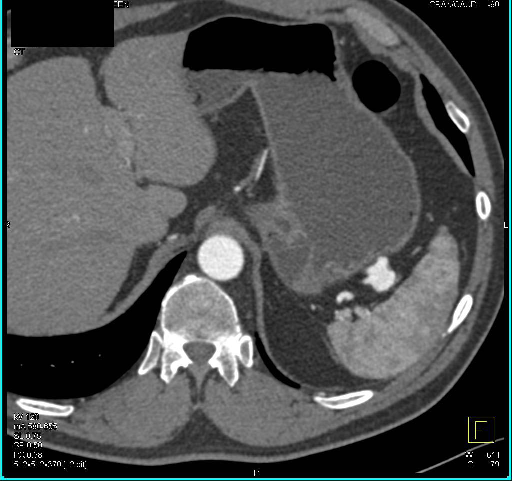 3D Rendering of a Splenic Artery Aneurysm - CTisus CT Scan