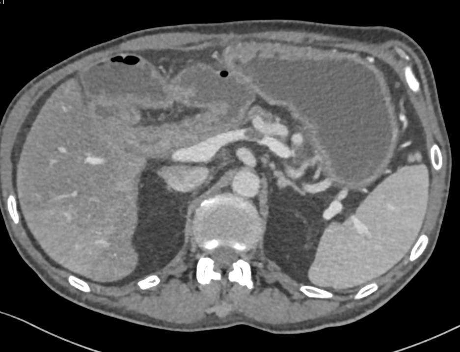 Splenic Vein Clot S/P Whipple Procedure - CTisus CT Scan