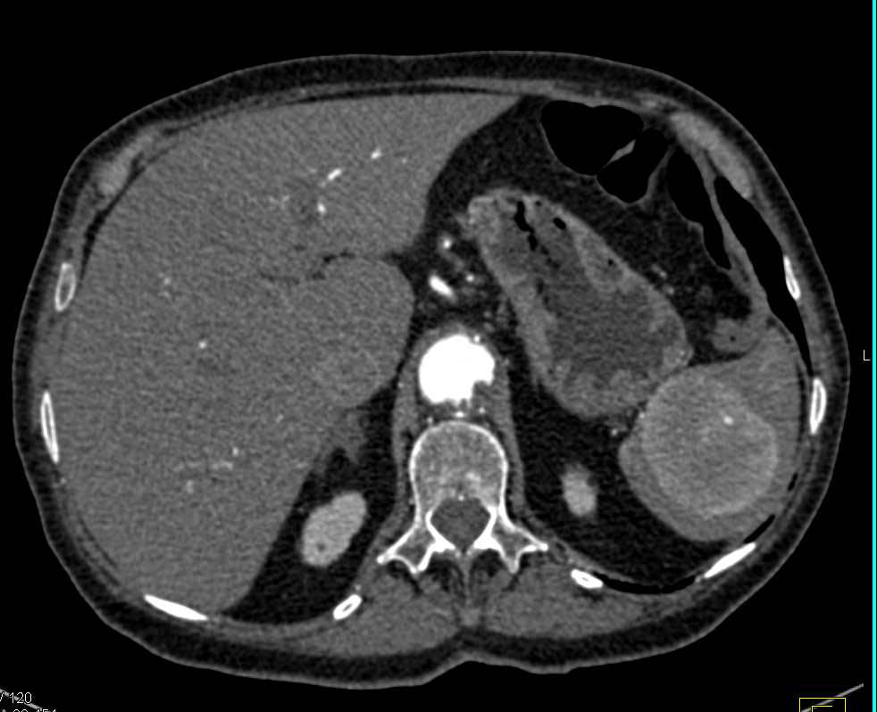 Splenic Hamartoma - CTisus CT Scan