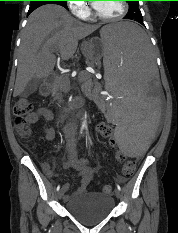 Massive Splenomegaly with Multiple Splenic Infarcts - CTisus CT Scan