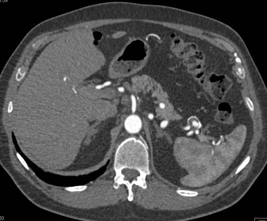 Splenic Artery Aneurysm - CTisus CT Scan