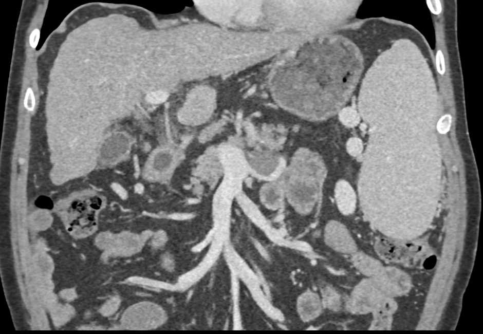 Splenic Vein Thrombosis - CTisus CT Scan