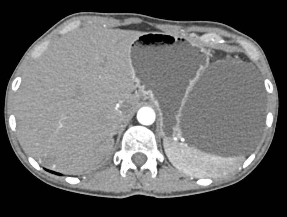 Epidermoid Cyst Spleen - CTisus CT Scan