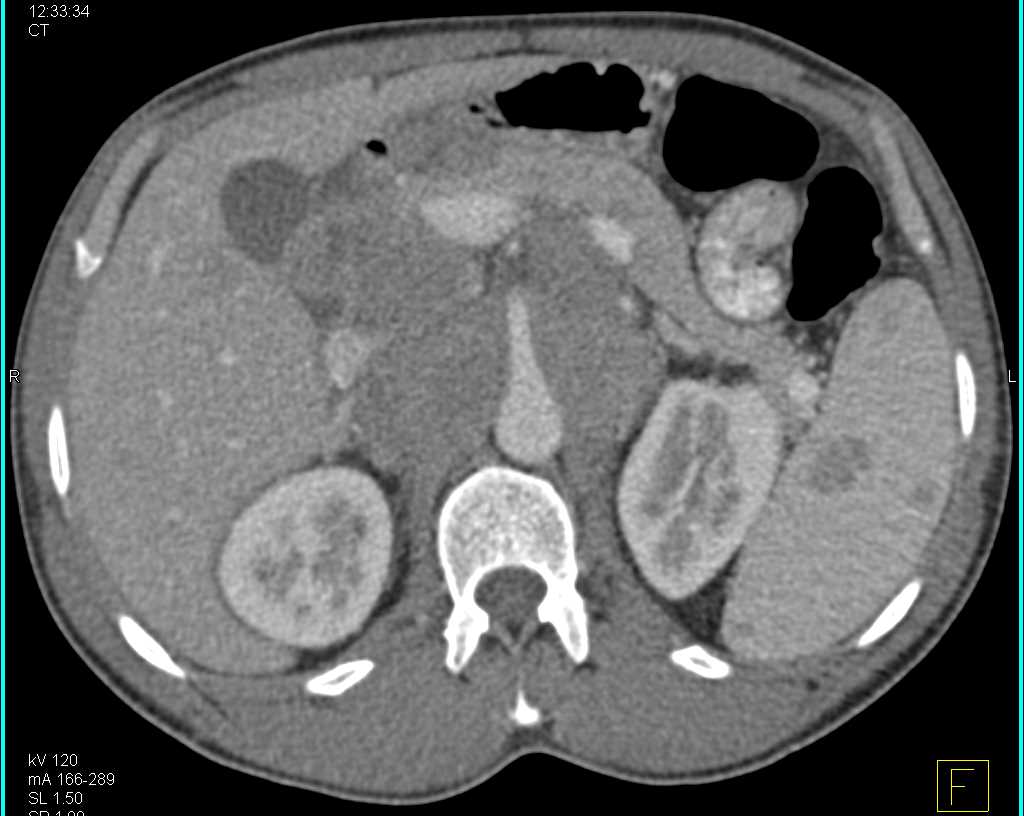 Lymphoma Involves the Liver, Spleen and Lymph Nodes - CTisus CT Scan