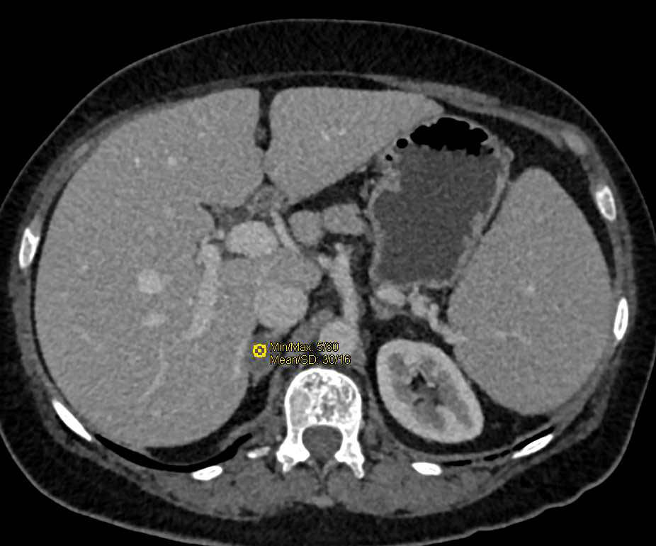 Marked Splenomegaly in a Patient with Myelofibrosis - CTisus CT Scan