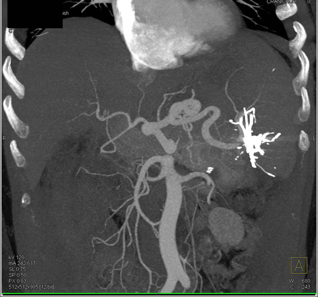 Splenic Infarct s/p Splenic Artery Embolization - CTisus CT Scan