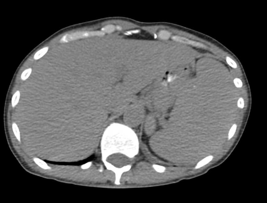Calcified Splenic Cyst - CTisus CT Scan