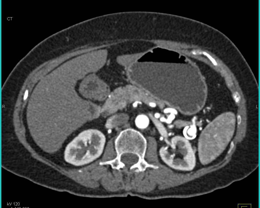 Splenic Artery Aneurysm - CTisus CT Scan