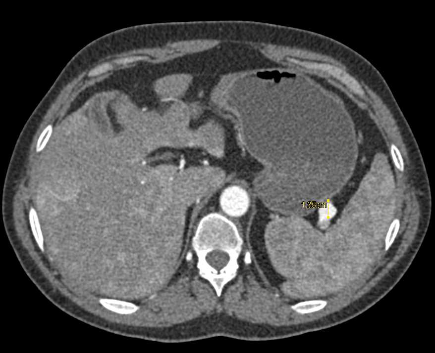Splenic Artery Aneurysm - CTisus CT Scan
