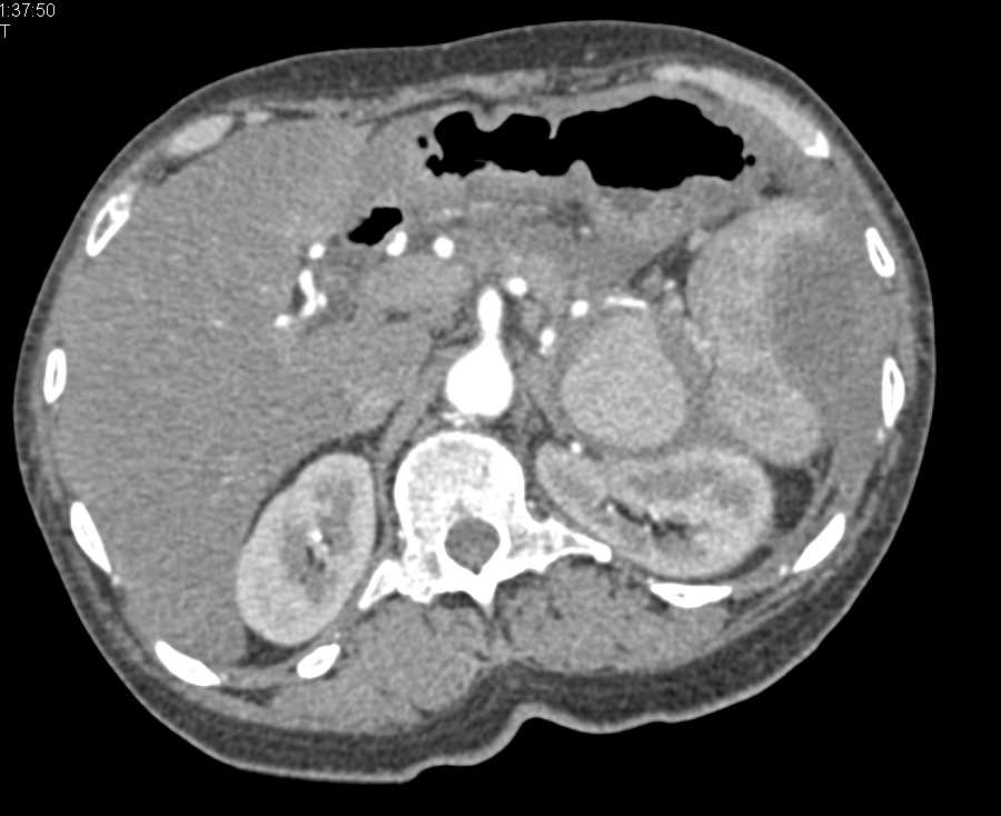 Coiled Splenic Artery Aneurysm and Subcapsular Collection Spleen - CTisus CT Scan