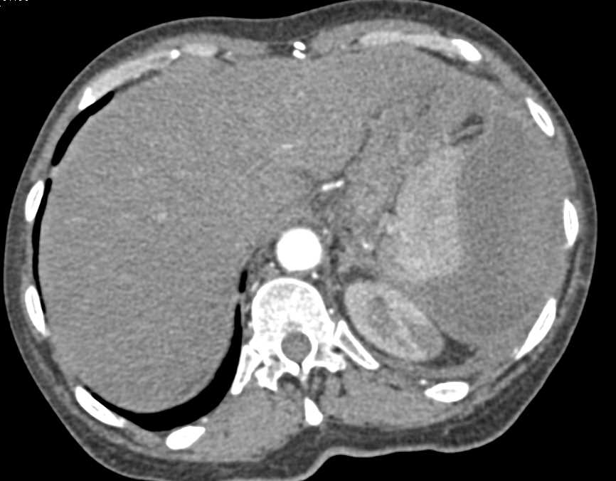 Coiled Splenic Artery Aneurysm and Subcapsular Collection Spleen - CTisus CT Scan