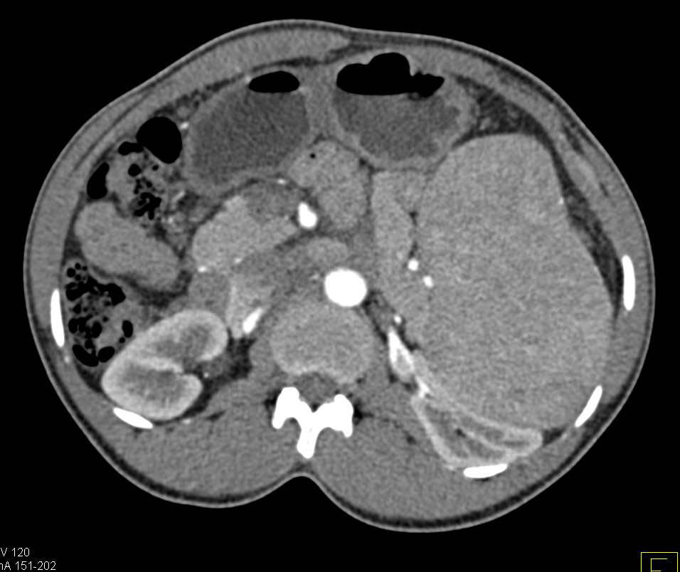 Chronic Lymphocytic Leukemia (CLL) with Marked Splenomegaly - CTisus CT Scan