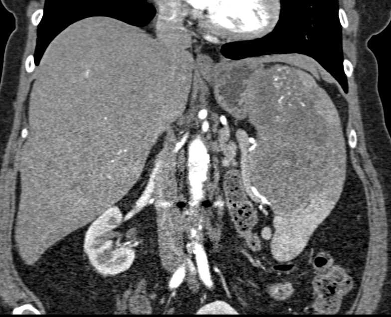 Splenic Lymphoma - CTisus CT Scan
