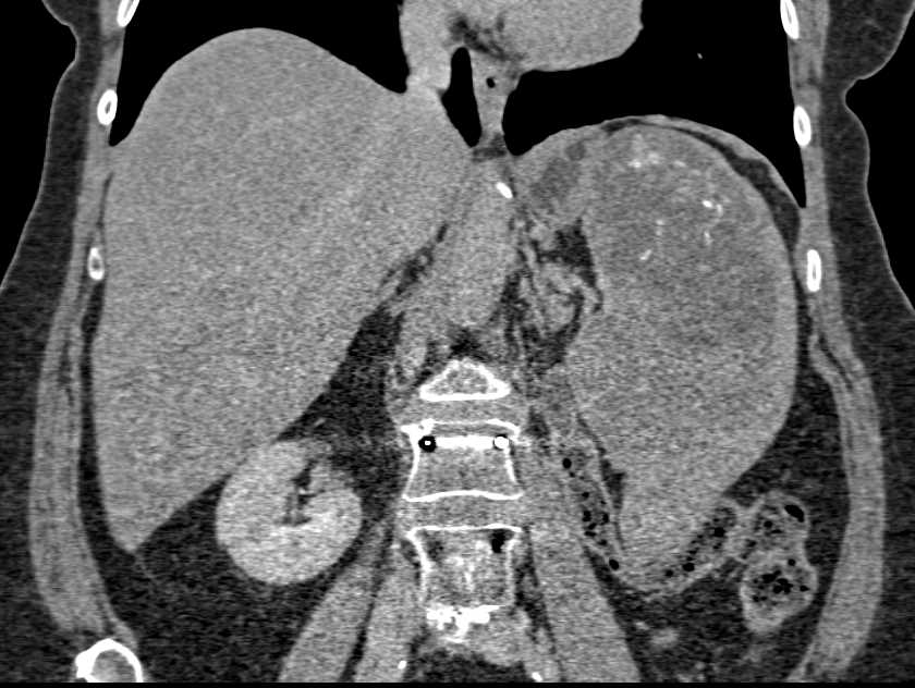 Splenic Lymphoma - CTisus CT Scan