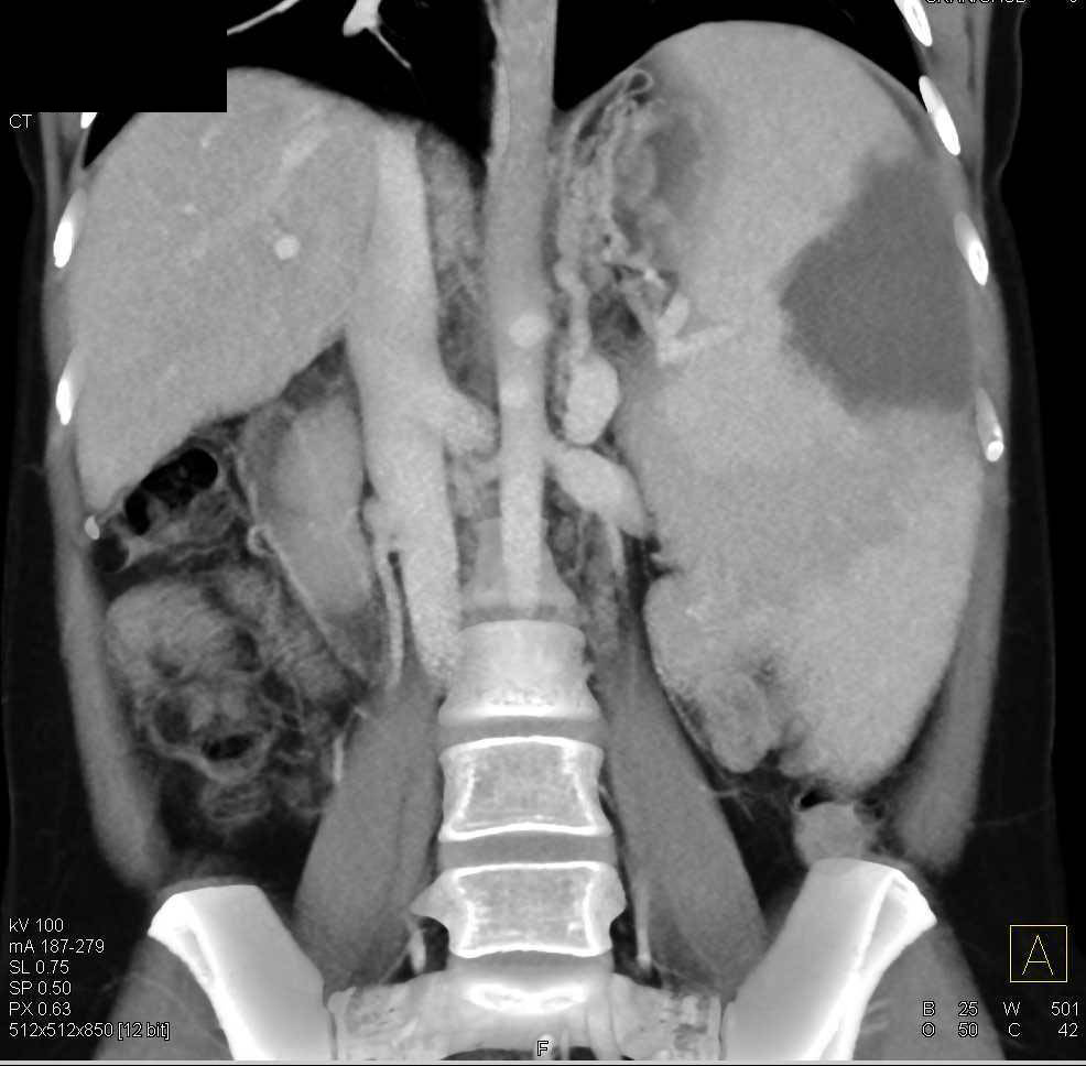 Splenic Infarction in a Patient with Portal Hypertension - CTisus CT Scan