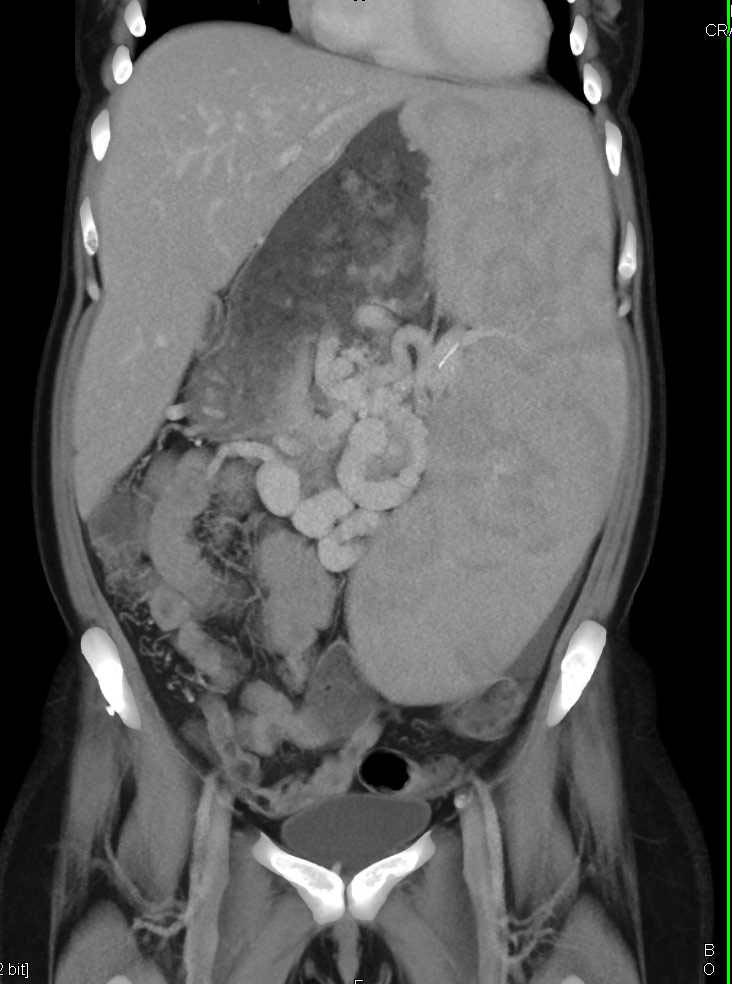 Massive Splenomegaly and Portal Hypertension - CTisus CT Scan
