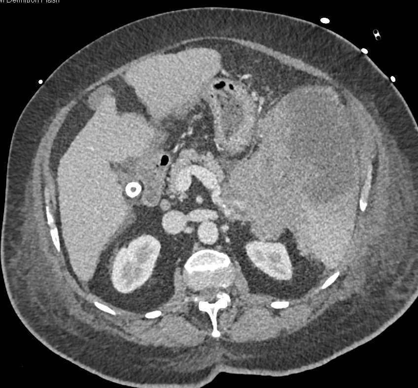 Splenic Lymphoma - CTisus CT Scan