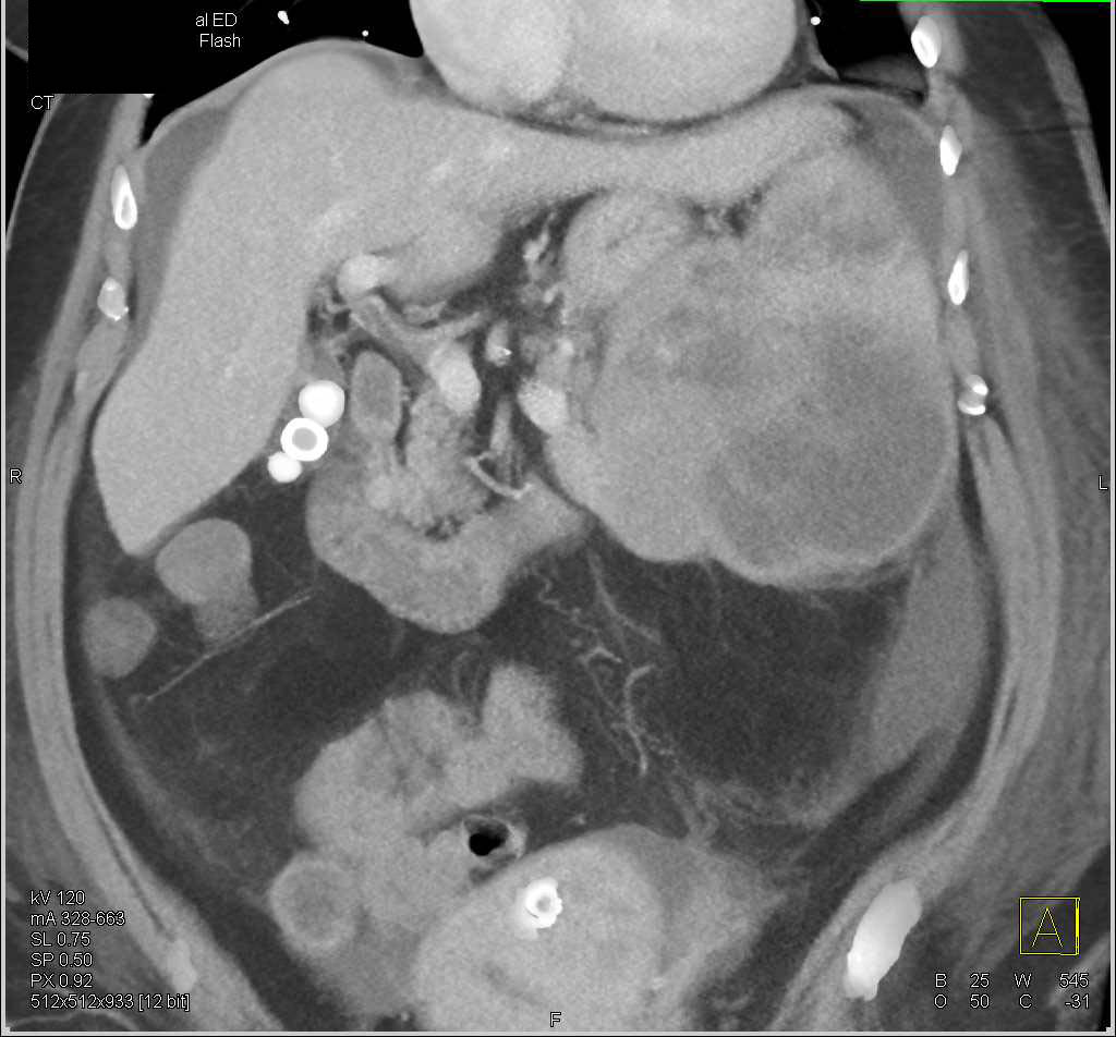 Splenic Lymphoma - CTisus CT Scan