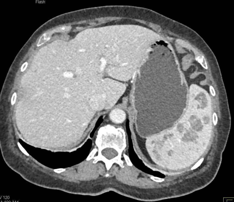 Splenic Sarcoidosis - CTisus CT Scan