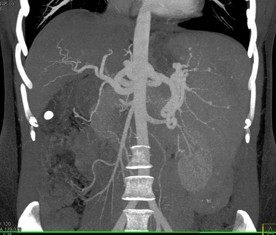 Cirrhosis and Splenomegaly with Multiple Small Splenic Artery Aneurysm - CTisus CT Scan