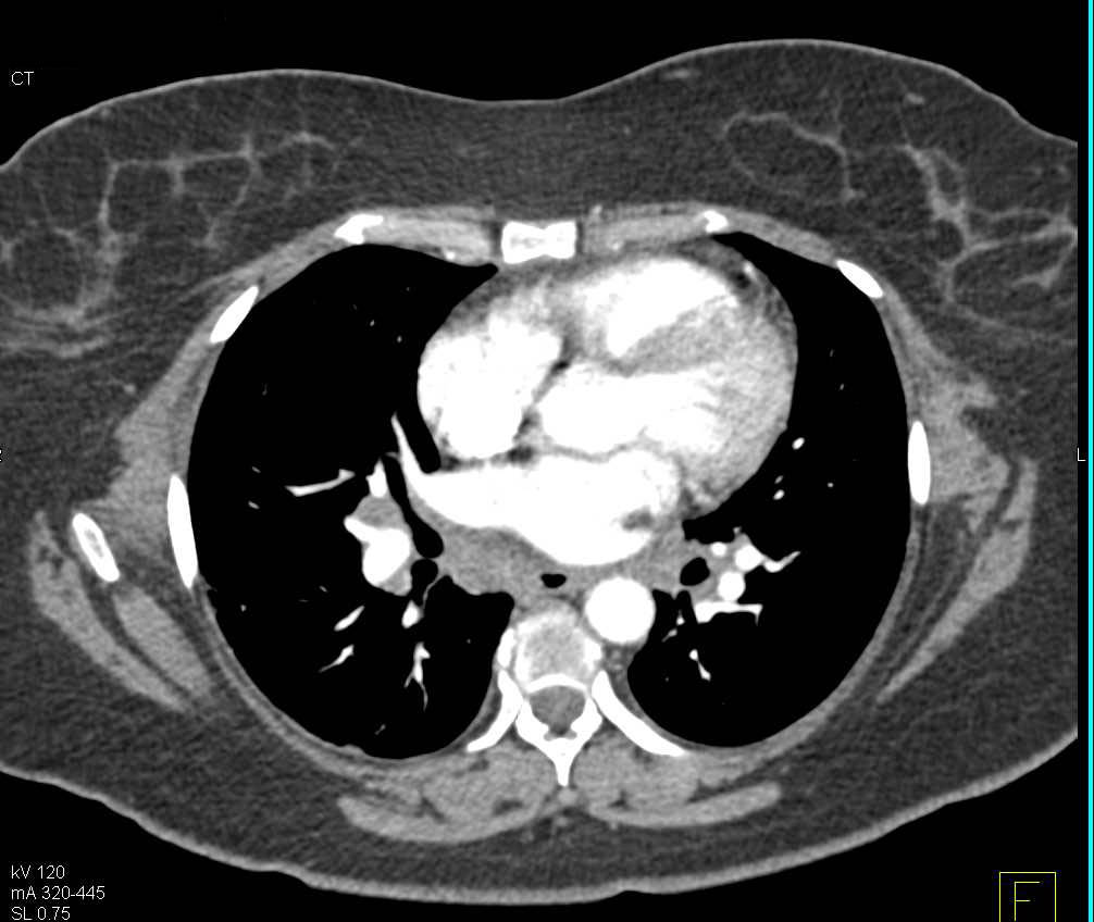 Sarcoidosis Involves the Spleen with Acute Pancreatitis as Well - CTisus CT Scan
