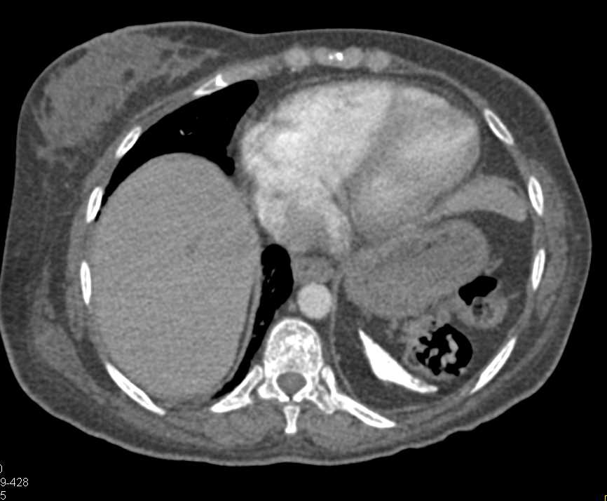 Calcified Spleen in Sickle Cell Disease - CTisus CT Scan