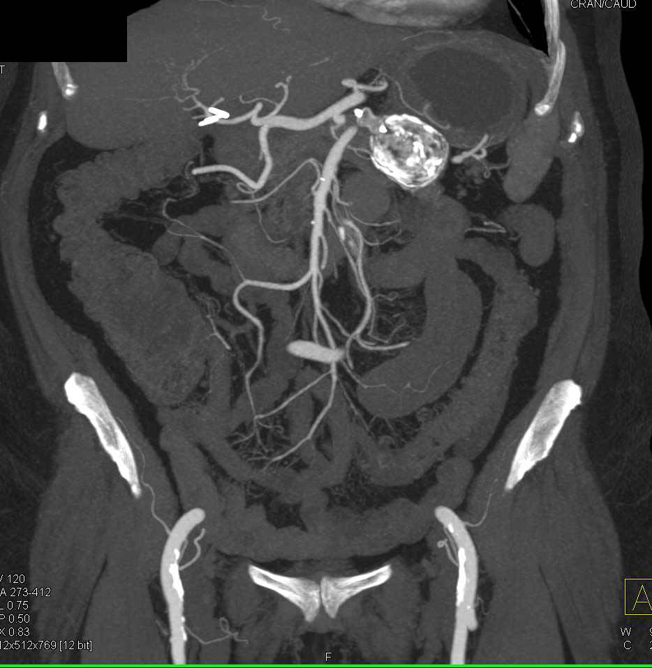 Calcified Splenic Artery Aneurysm - CTisus CT Scan