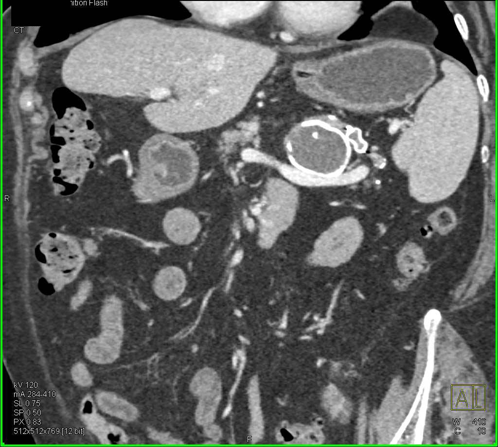 Calcified Splenic Artery Aneurysm - CTisus CT Scan
