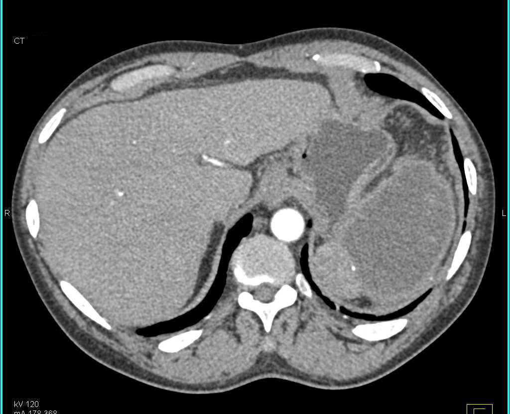 Splenic Infarct in a Cirrhotic Patient - CTisus CT Scan