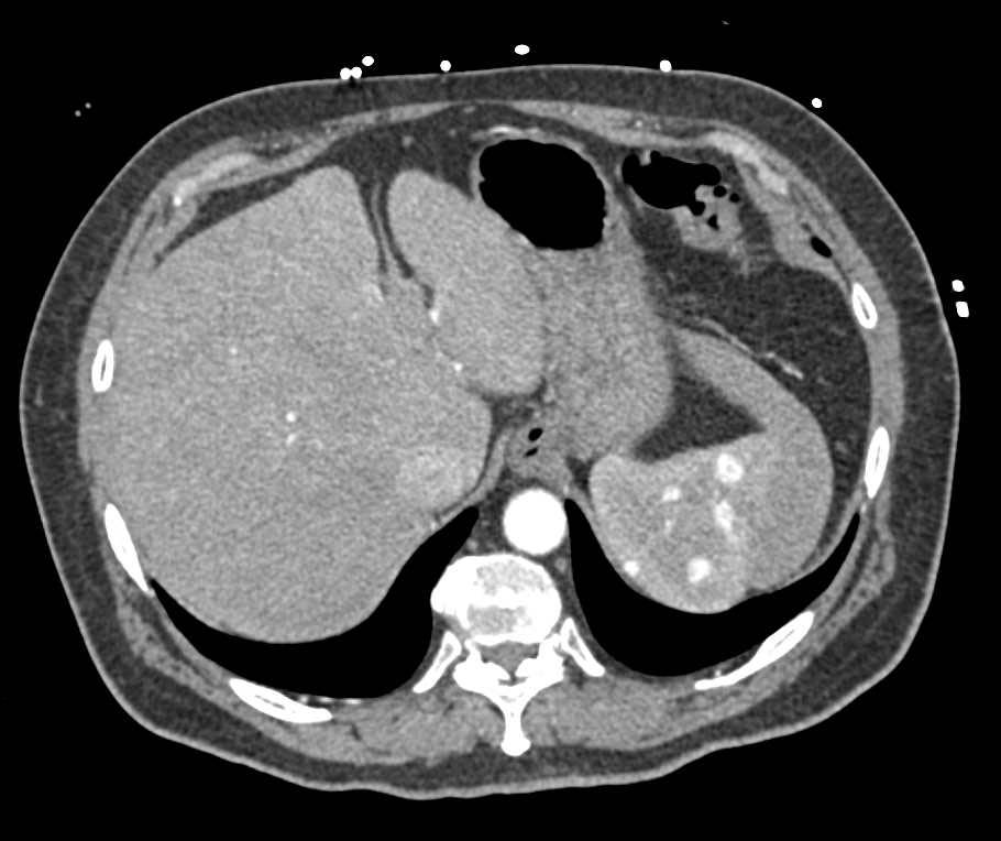Splenic Hemangiomas - CTisus CT Scan