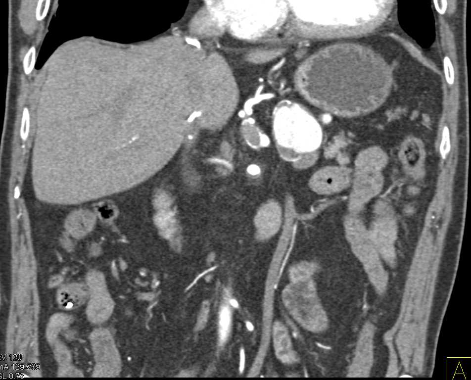 Large Splenic Artery Aneurysm - CTisus CT Scan