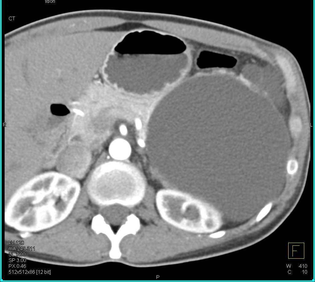 Splenic Cyst - CTisus CT Scan