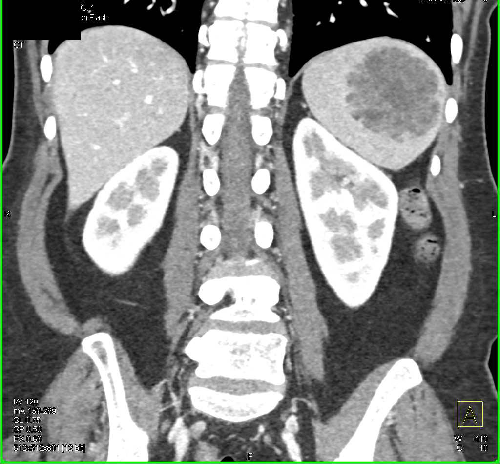 Splenic Hemangioma - CTisus CT Scan