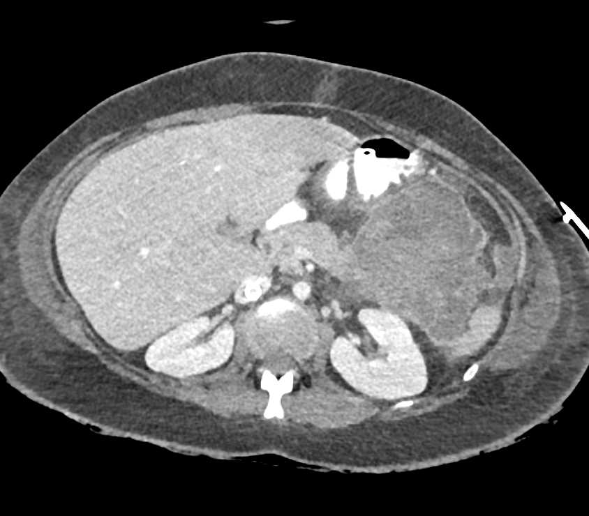 Left Upper Quadrant Collections Which Are hemorrhagic in Part - CTisus CT Scan
