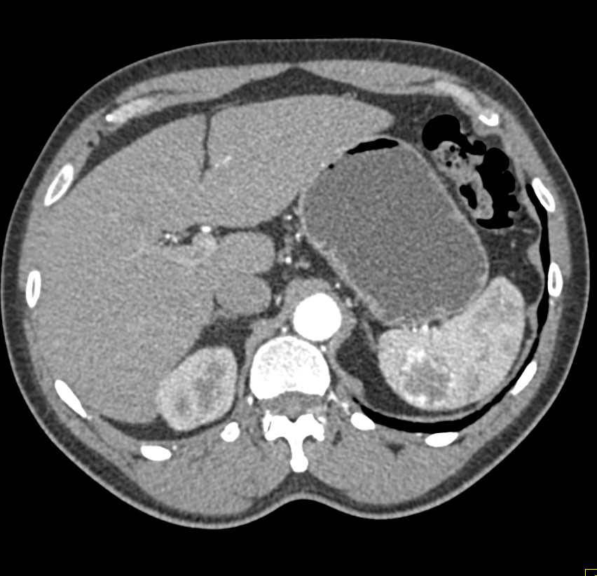 Splenic Hemangioma - CTisus CT Scan