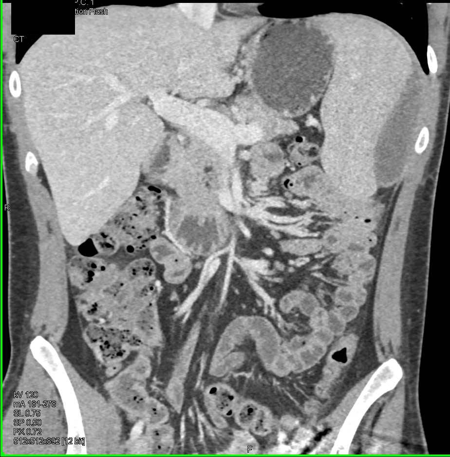 Implants on the Spleen - CTisus CT Scan