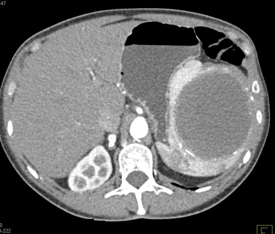 True Splenic Cyst - CTisus CT Scan