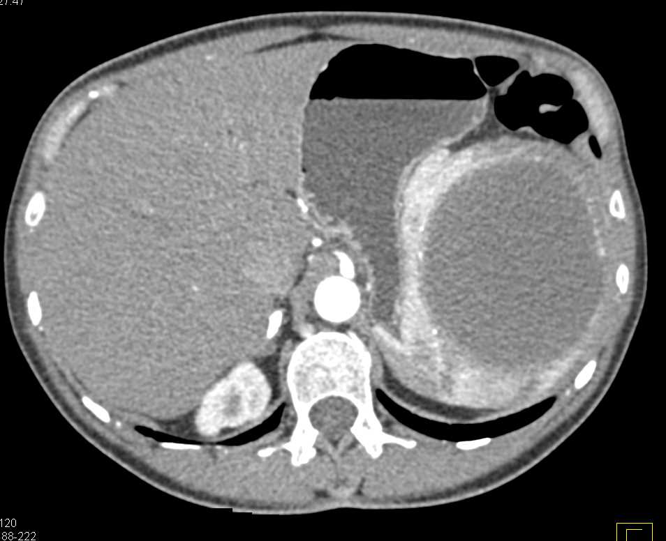 True Splenic Cyst - CTisus CT Scan